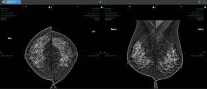 "Progressive Loading" launched on RamSoft's OmegaAI™ Cloud-Native Radiological Software Platform